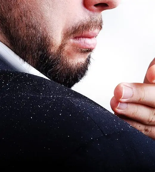 Dandruff